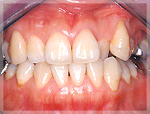 歯周外科症例 Before